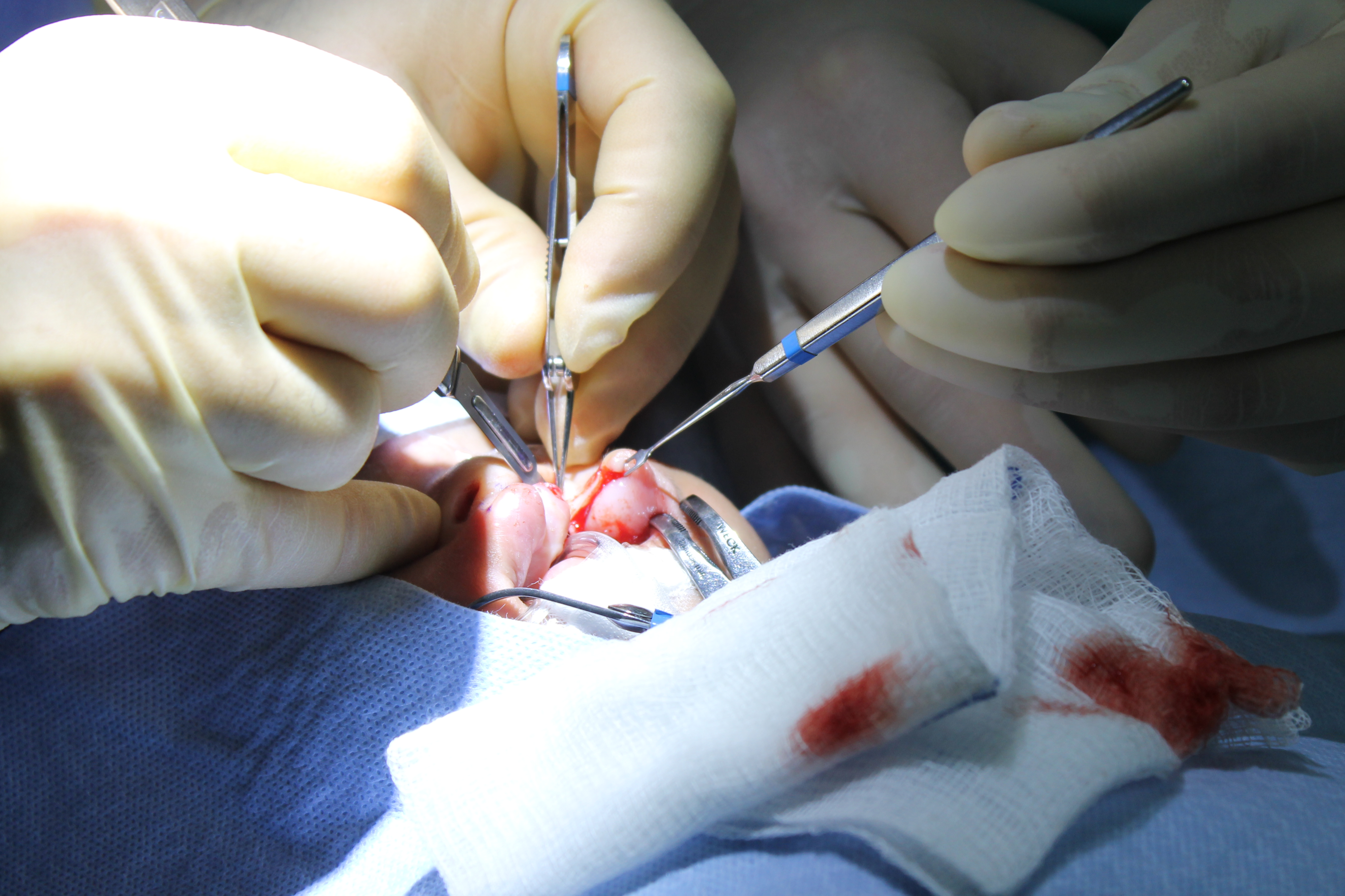 Dr. Brian works to bring the two sides of her lip together, while preserving as much tissue as possible.