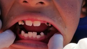 teeth with caries